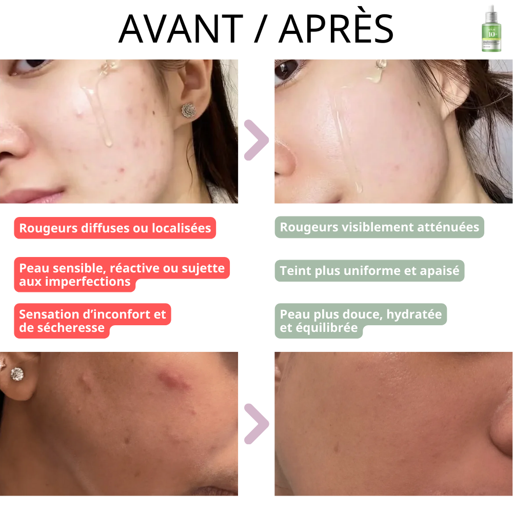Anua - Sérum Apaisant Anti-Rougeurs à l'Acide Azélaïque 10%