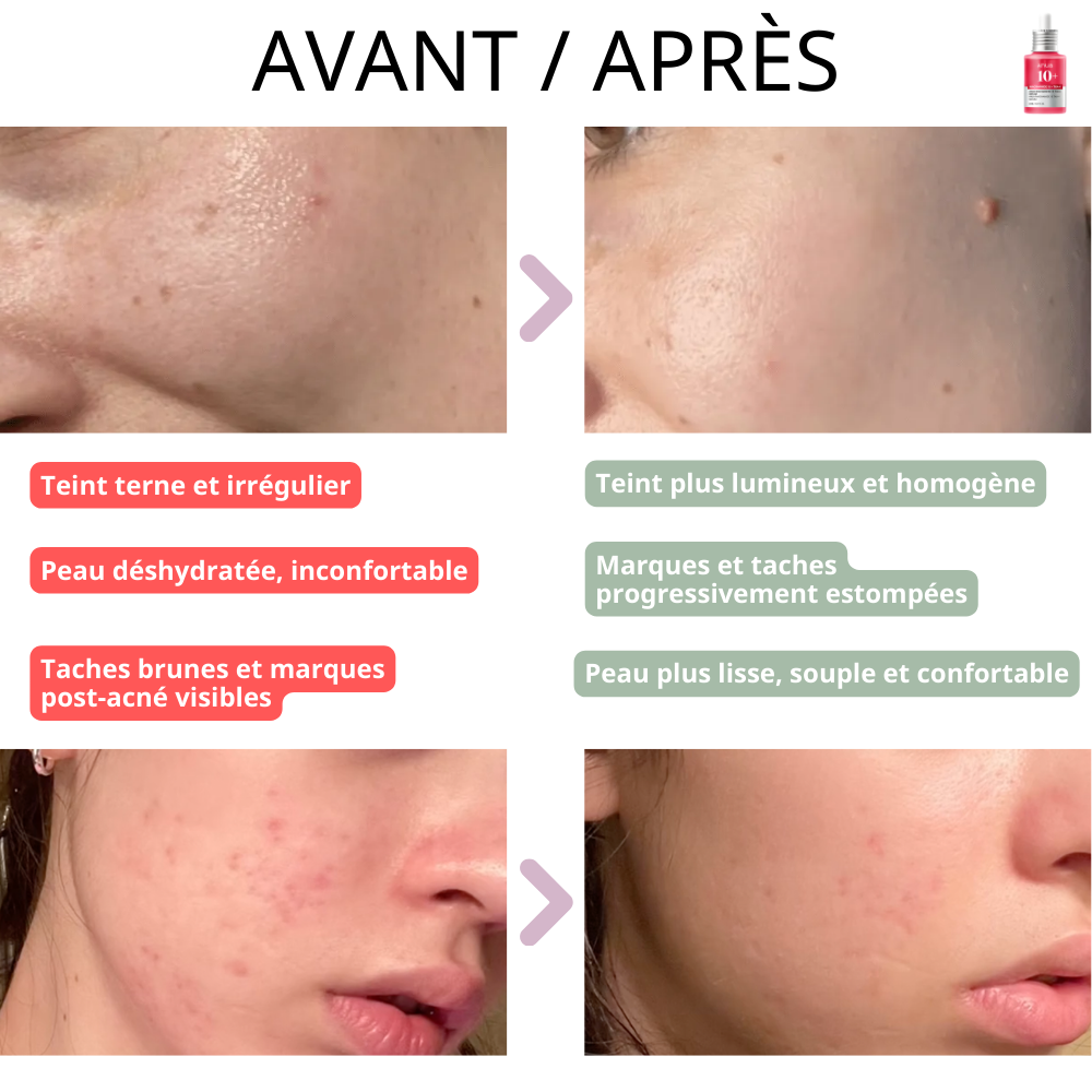 Anua - Sérum Anti-Taches Éclat au Niacinamide 10% et Acide Tranexamique 4%