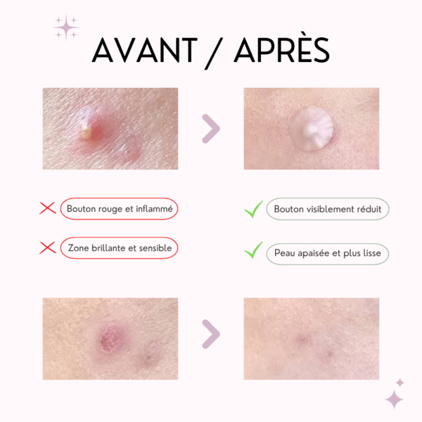 cosrx – patch boutons anti imperfections