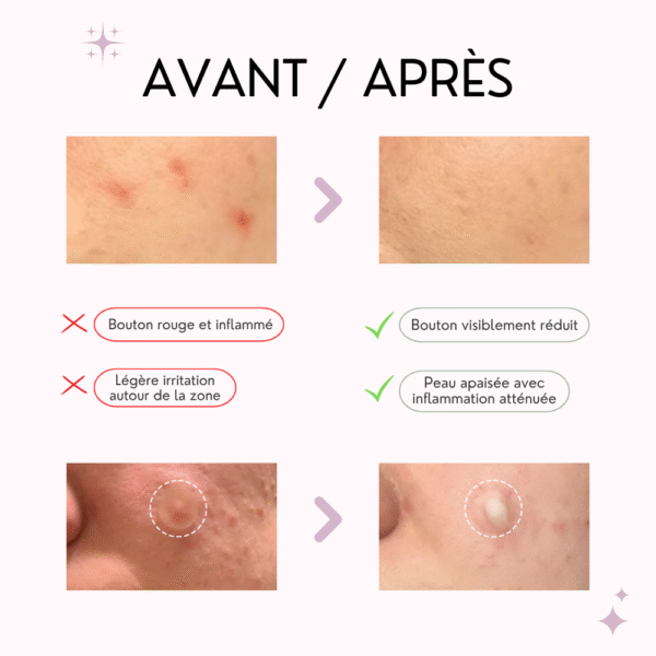 some by mi patch boutons, anti imperfections – 18 patchs