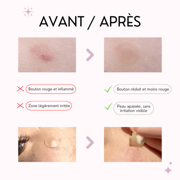 vt patch cica anti imperfections, anti acné