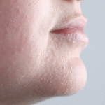dehydrated skin