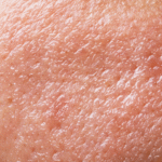 peau grasse, pores dilatés
